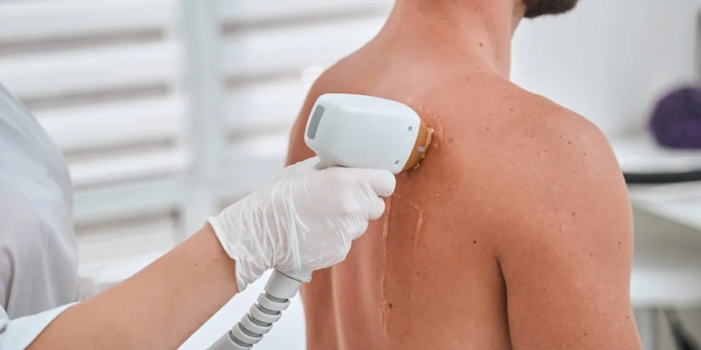 Back and Chest Laser Hair Removal for Men What to Expect from Start to Finish