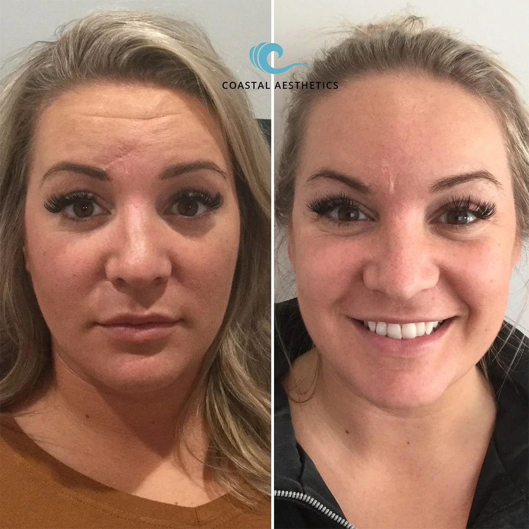 Before and After Botox to forehead