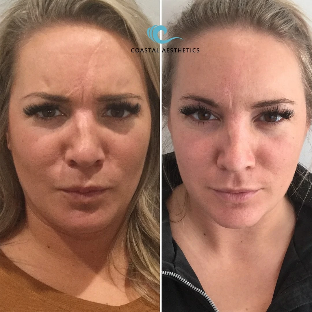 Before and After with Botox to scowl