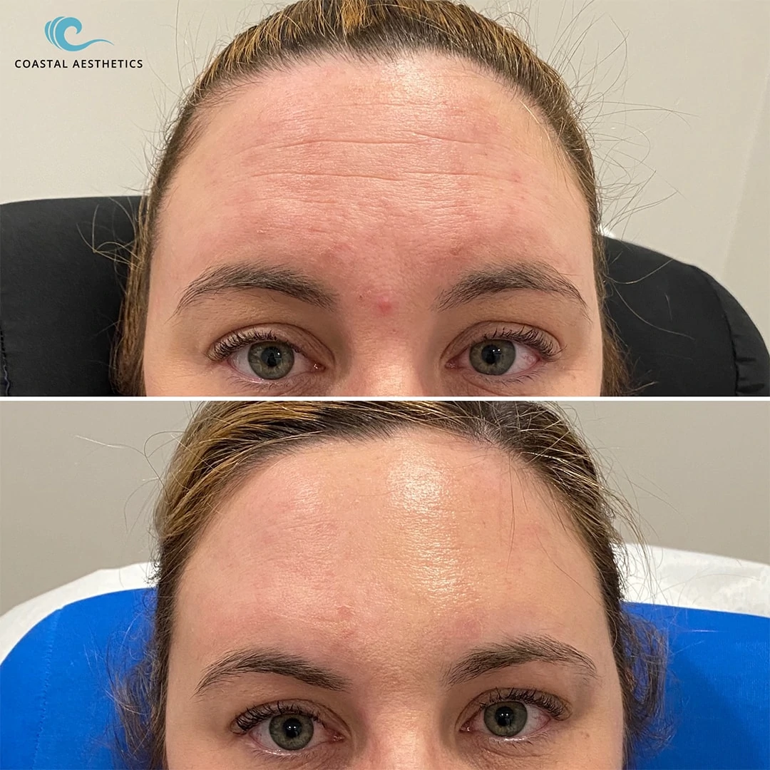 Before and after Botox to forehead (2)