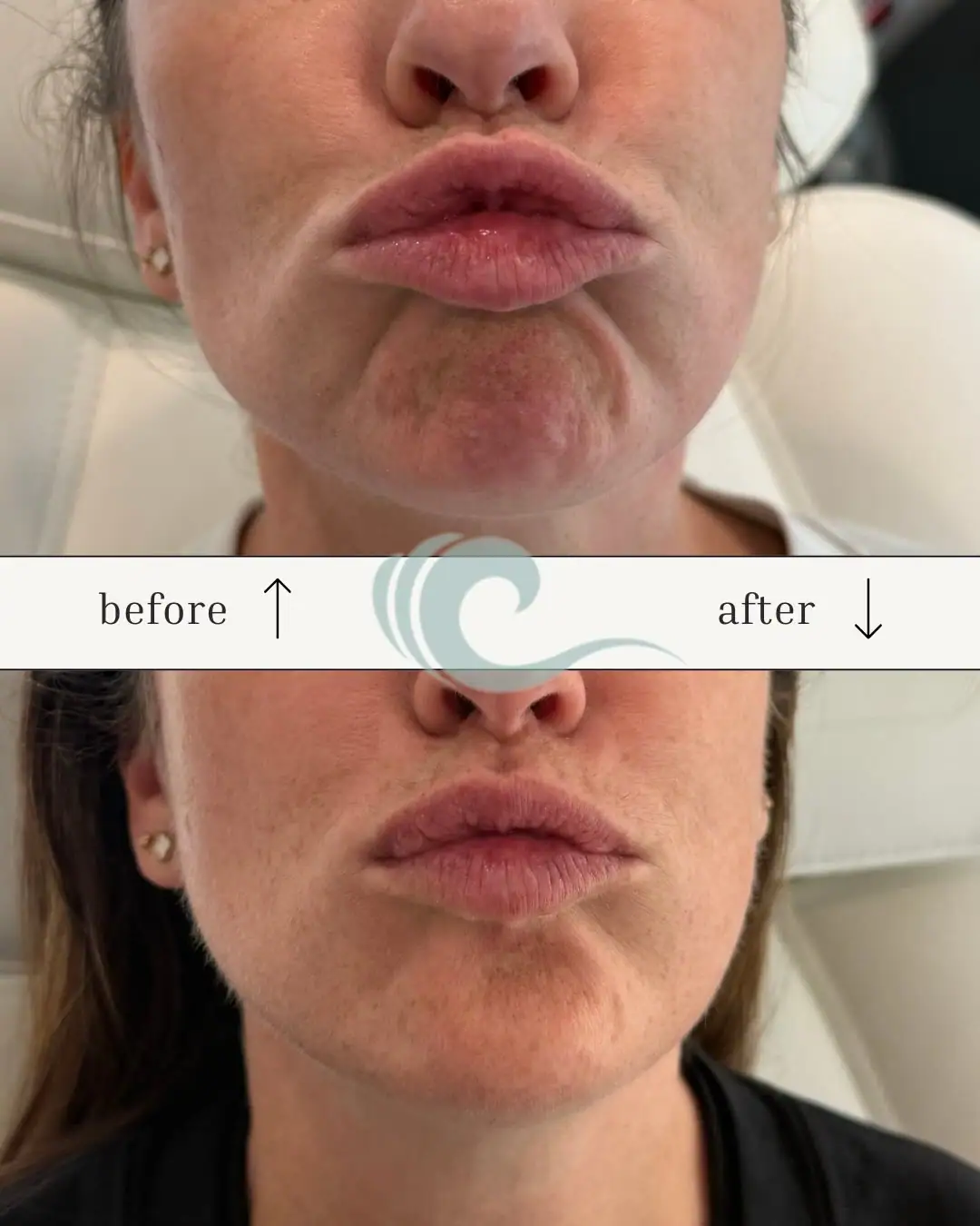 Botox beyond the upper face