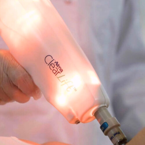 Clearlift Laser 3 Treatment Series