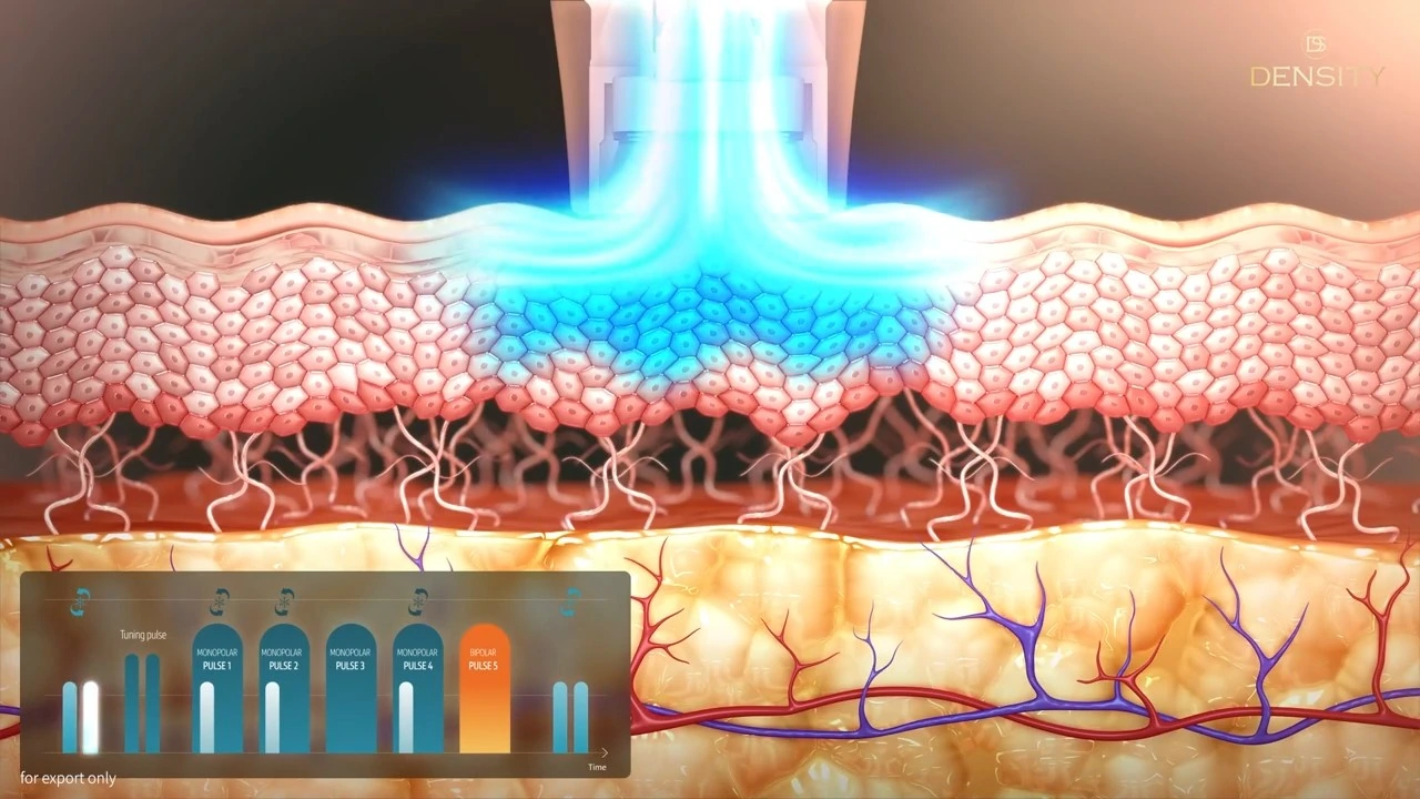 DENSITY profile and clinical confidence
