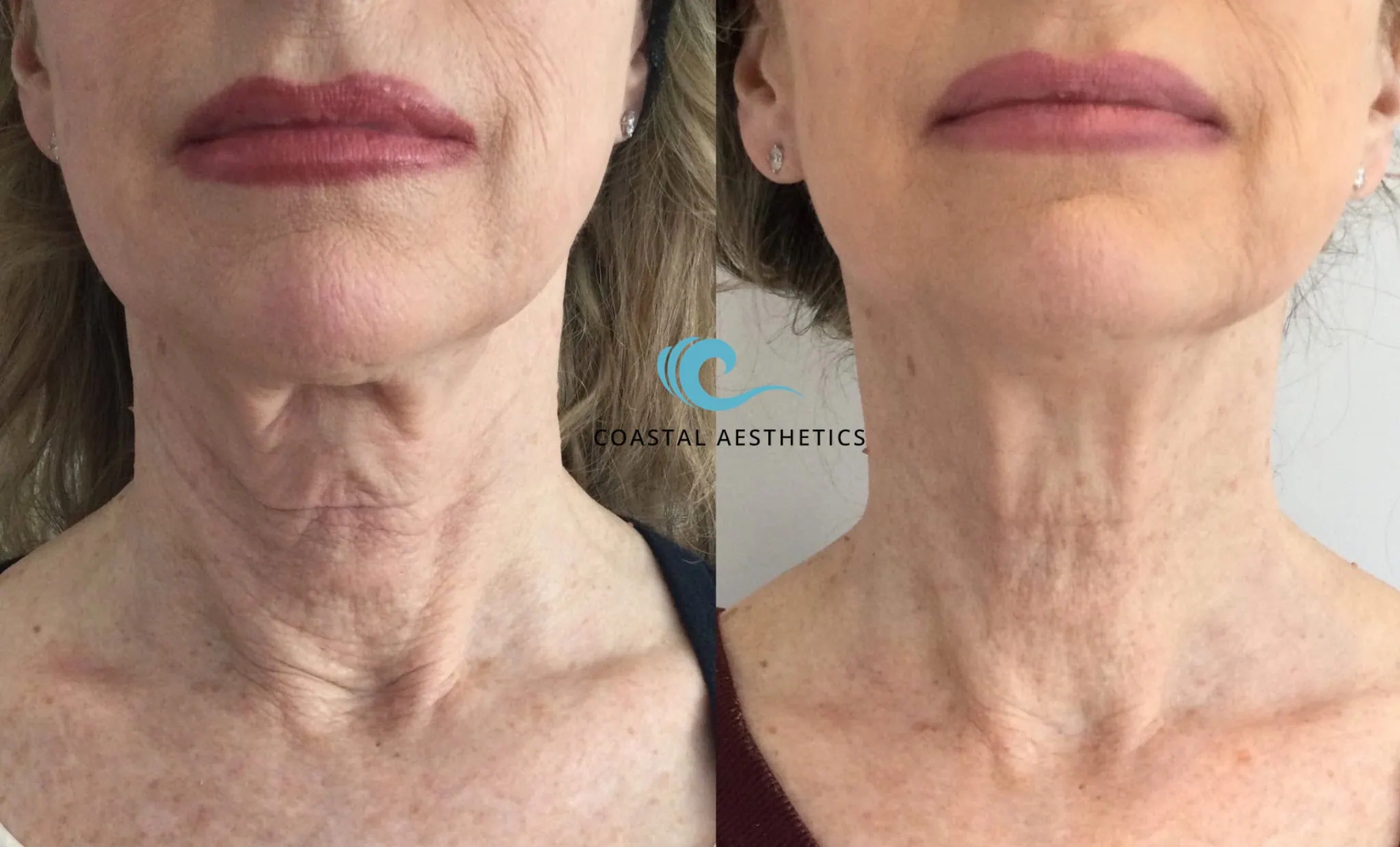 Nefertiti neck lift before and after