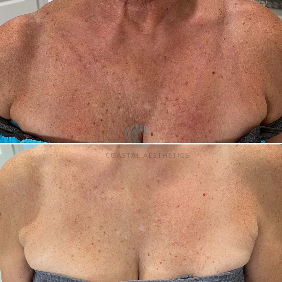 Opus-Plasma-RF-before-after