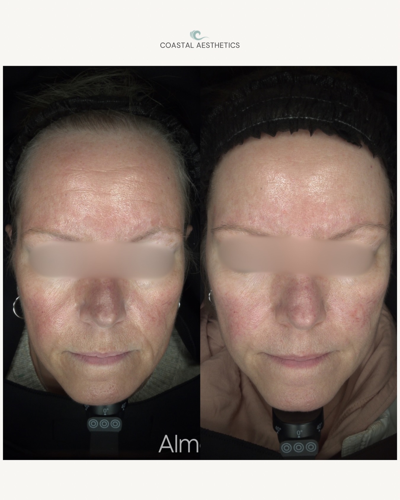 Opus Plasma before and after portland maine