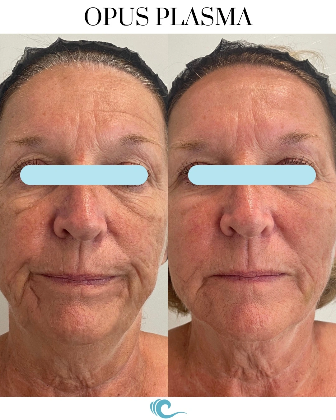 Opus Plasma before and after