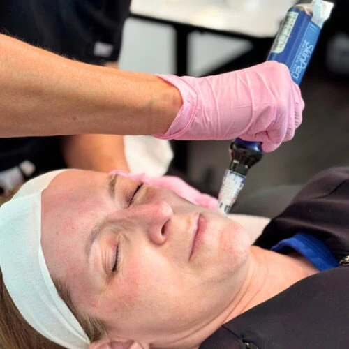 Peel Fusion (Microneedling + Stim Peel) 3 Series peel fusion