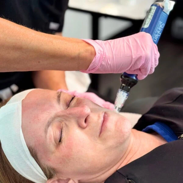 Peel Fusion (Microneedling + Stim Peel) 3 Series peel fusion