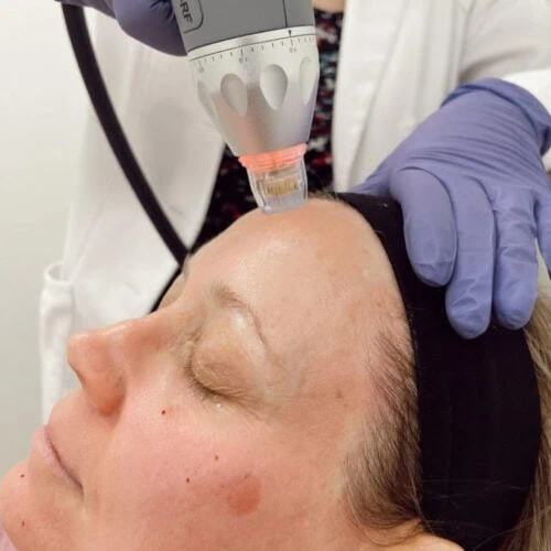 RF Microneedling 3 Treatment Series rf microneedling 3