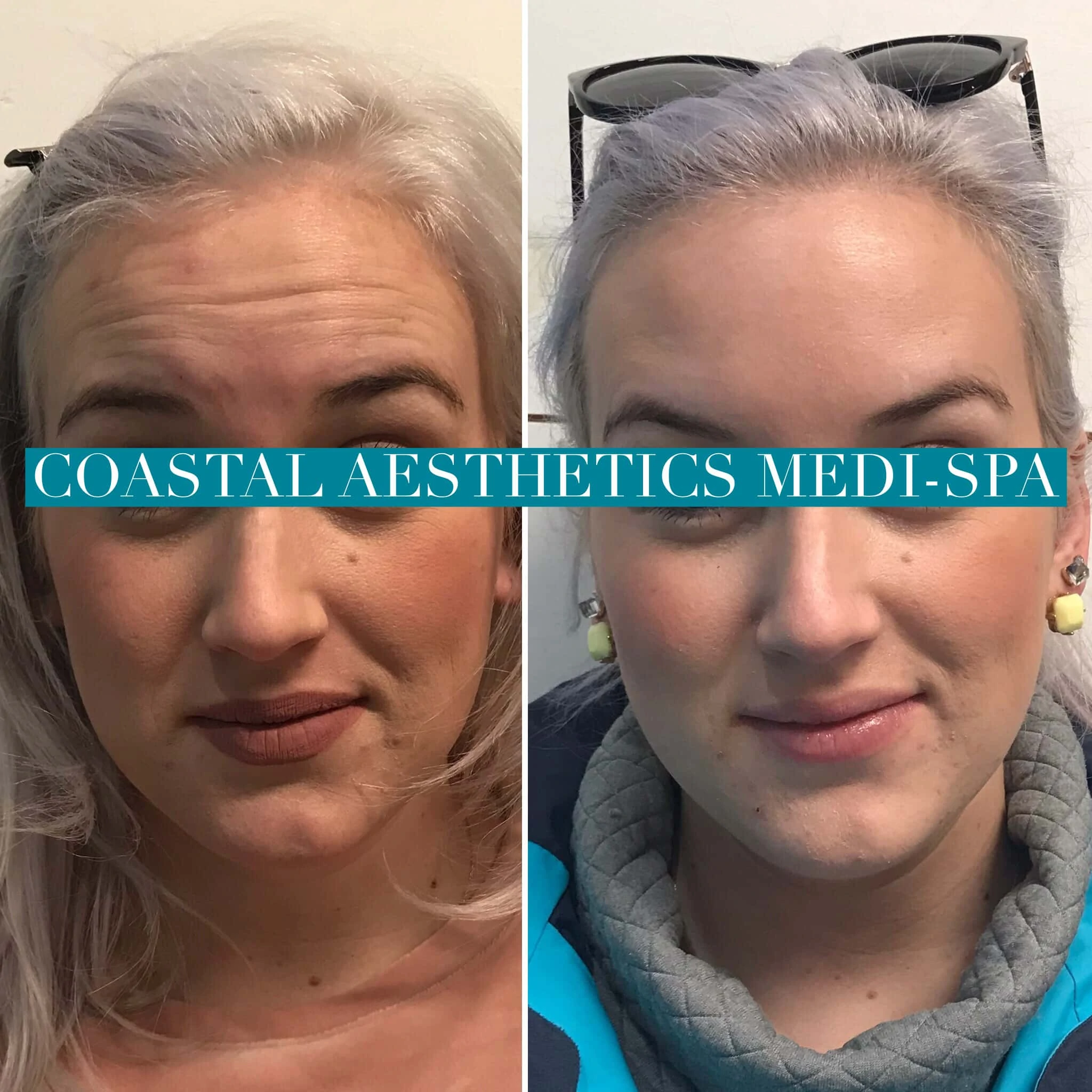 botox-before-after-2