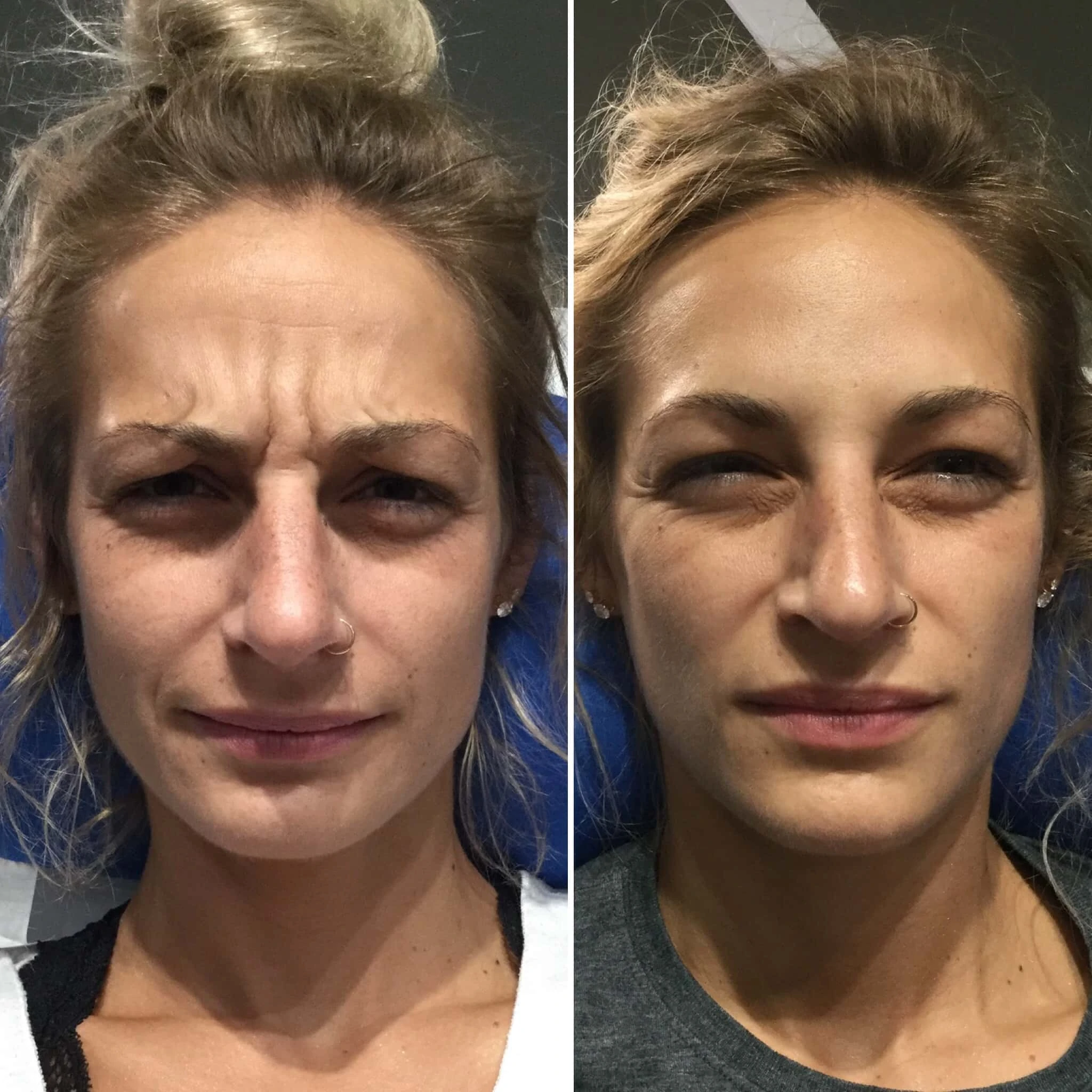 botox-before-after-4
