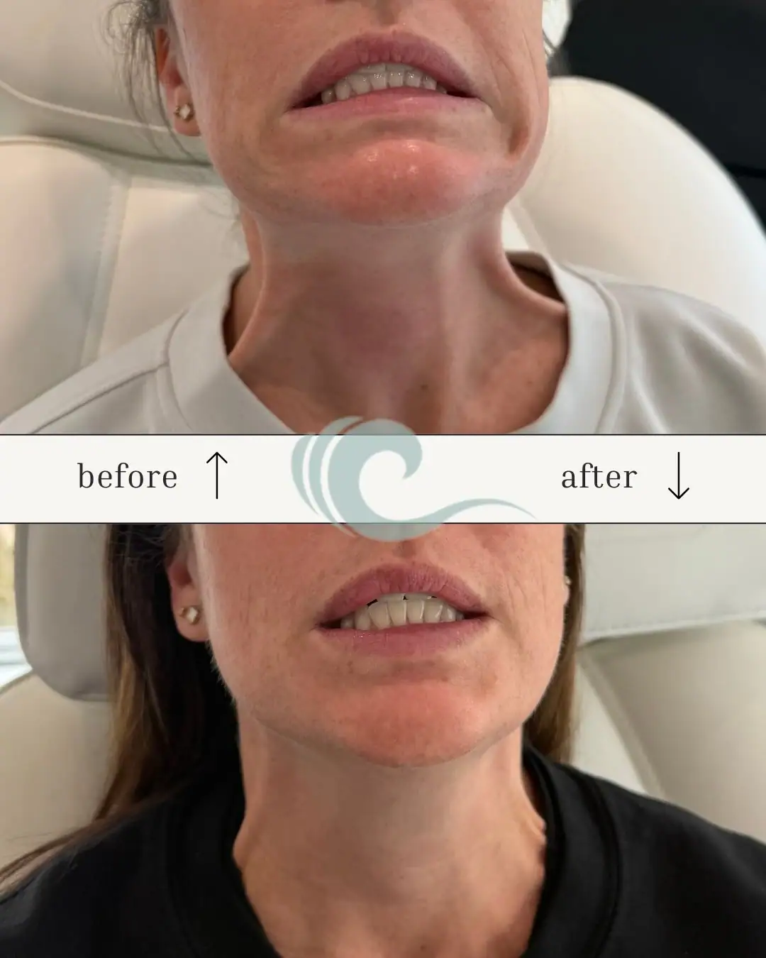 botox results