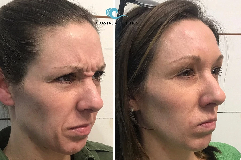 Women after Botox