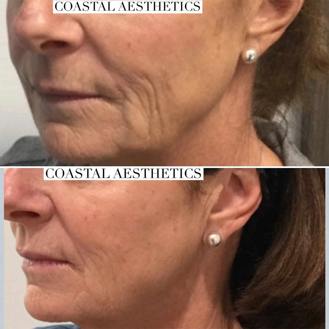 Before & After opus treatment