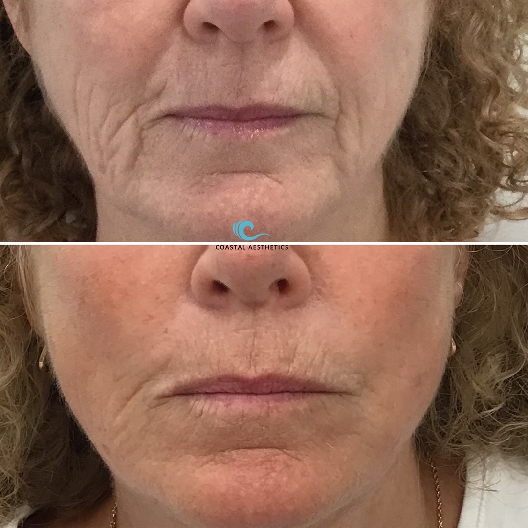 Opus Plasma RF Skin Resurfacing in York, Maine Coastal Opus Plasma RF Skin Resurfacing in York, Maine Coastal